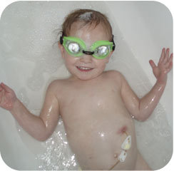 Hannah in bathtub showing the inserted feeding tube to her stomach