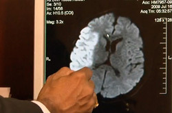 Brain scan showing massive stroke damage