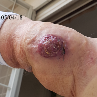 Large cancerous tumor on the man's right arm